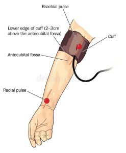 blood-pressure-cuff-arm-drawing-over-brachial-pulse-created-adobe-illustrator-contains-gradients-eps-52515064-2813373